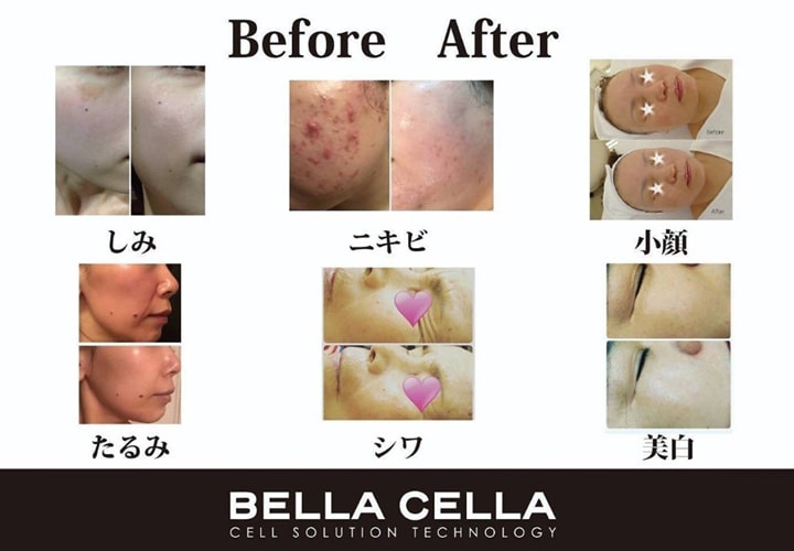 ベラセーラ ビフォー アフター